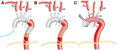 Improvement of Clinical Outcomes of Total Aortic Arch Replacement and Frozen Elephant Trunk Surgery With Aortic Balloon Occlusion